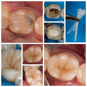 Зубы после эндодонтологии