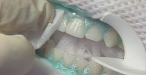Как проходит минерализация зубов