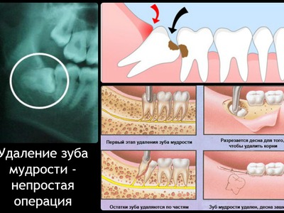 Как растут коренные зубы у детей схема