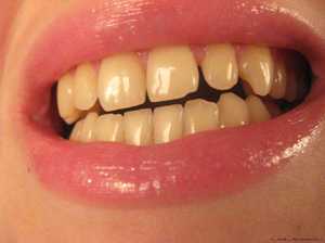 От чего зубы желтые