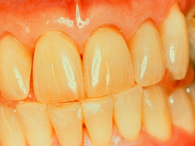 Желтые зубы причины и решения