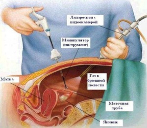 Лапороскопия кисты