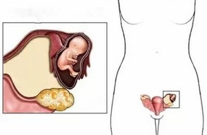 Киста при беременности