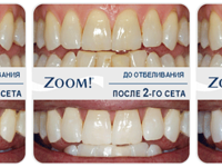 Новейший способ отбеливания зубов — Zoom 4