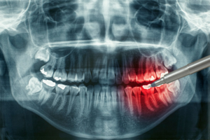 Важность рентгеновского исследования зубов