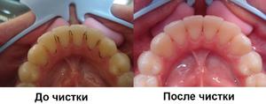 Достоинства метода удаления зубного камня