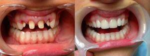 Какие бывают зубные коронки