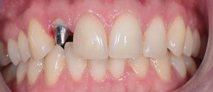Как установить коронки на передние зубы