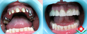 Зубные коронки на передние зубы