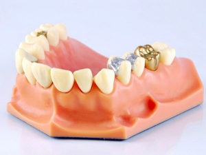 Коронки на зубы из золота