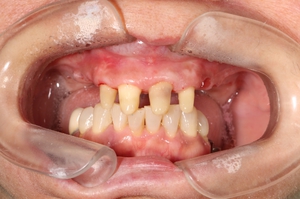 Депульпация зубов