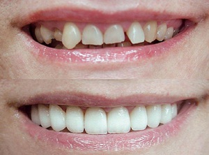 Описание эстетической реставрации зубов