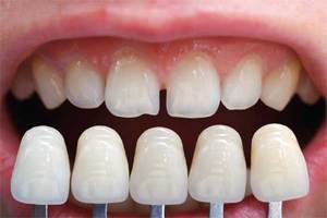 Применение люминиров для эстетической реставрации зубов