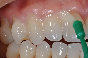 Описание метода выполнения композитной реставрации зубов