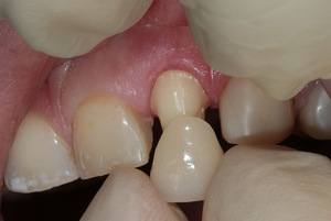 Описание метода эстетической реставрации зубов с помощью керамических коронок