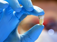 Удаление зубов-методы