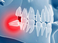 Что такое ретенция зуба