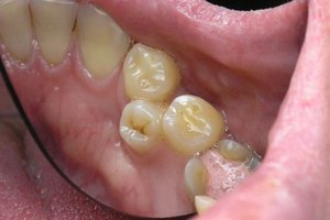 Из-за чего появляется ретенция зуба