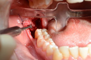 Операции по удалению ретинированного зуба
