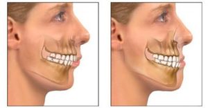Как выявить патологию верхней челюсти