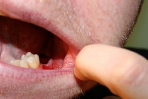 Этапы заживления лунки после удаления зуба мудрости