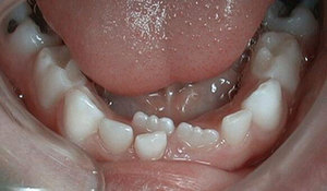 Почему коренные зубы криво растут
