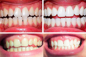 Как не навредить зубам во время отбеливания