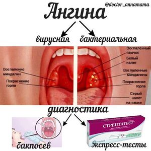 Классификация ангины