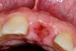 Внешний вид лунки после удаления зуба через 3 недели