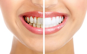 Особенности устранения зубного налёта в домашних условиях