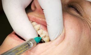 Последствия удаления зуба