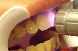 Как происходит отбеливание зубов