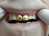 Описание коронок на зубы