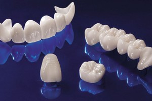 Описание неметаллических коронок на зубы