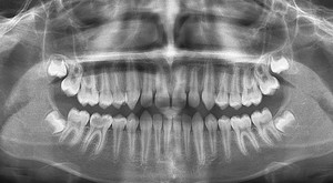 Панорамный снимок зубов показан на фото